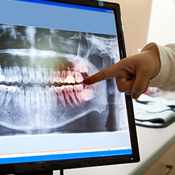 Panoramic dental x-rays on computer