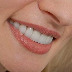 Closeup of beauitful smile following direct bonding