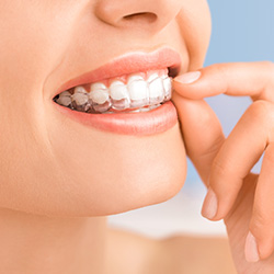 Closeup of patient placing Invisalign tray