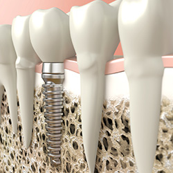 Animation of implant supported dental crown