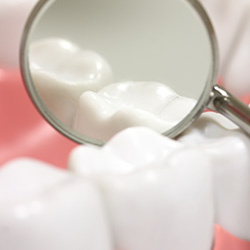 Closeup of teeth with dental sealants