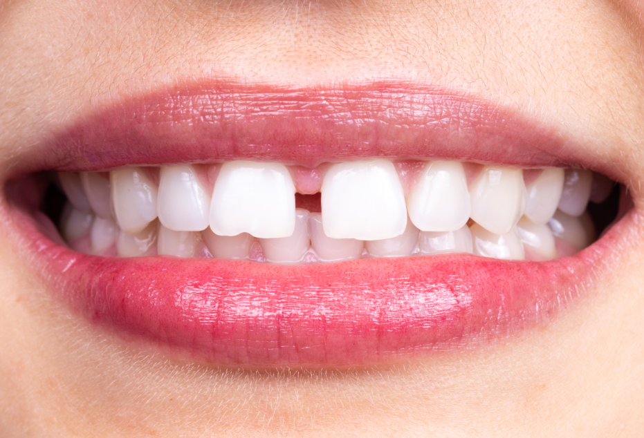 Close up of smiles with tooth gap